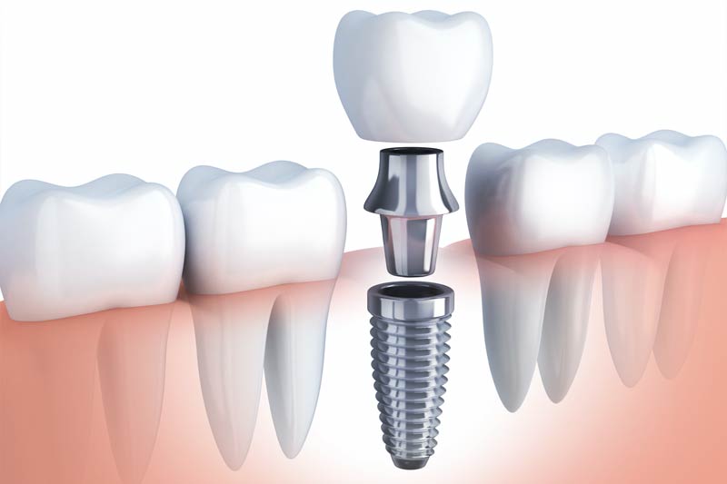 Implants Dentist in San Antonio